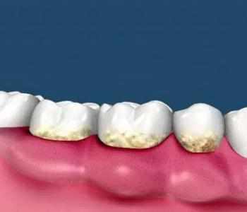 如何正确有效的防治牙结石