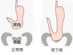 胃下垂怎么形成的