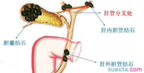 胆结石的治疗方法