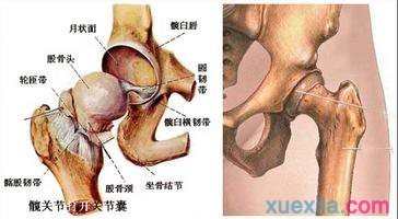 无菌性股骨头坏死治疗方法