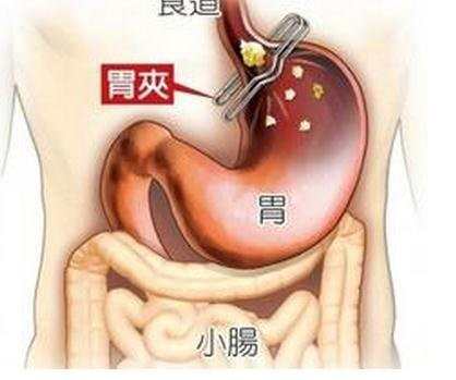 胃老胀气是什么原因