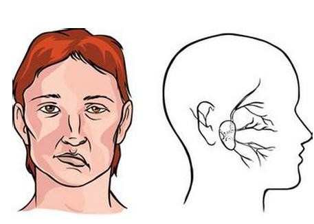 老年人面瘫的原因