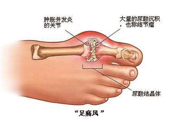 什么原因会引起痛风