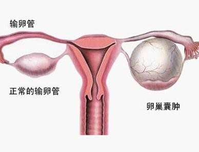 卵巢囊肿形成的病因