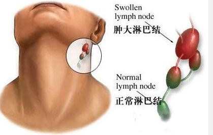 幼儿颈部淋巴结肿大的原因分析