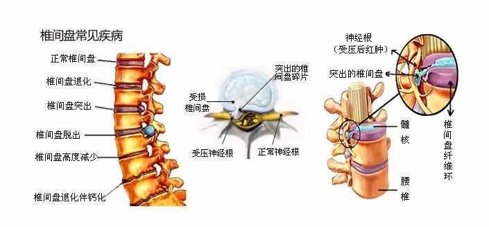 腰椎间盘突出的原因有什么