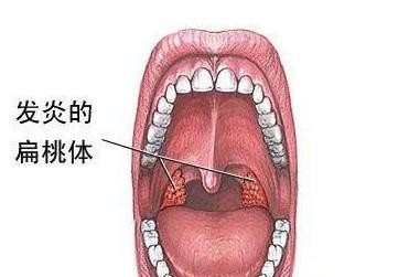 慢性扁桃体炎是怎么形成的