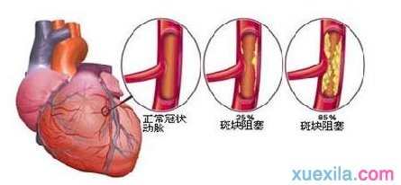 冠心病应该吃什么药_适合冠心病的药物推荐