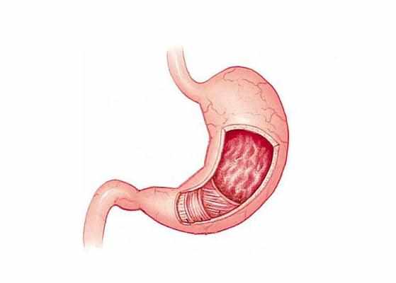 糜烂性胃炎怎么治疗效果好 糜烂性胃炎治疗方法