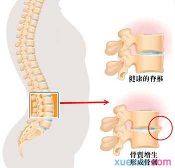 骨质增生吃什么药效果好_有效治疗骨质增生的药物