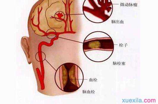 脑血栓形成的表现 脑血栓形成如何治疗