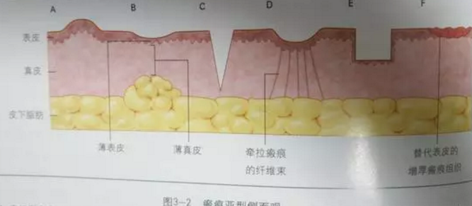 疤痕增生怎么办